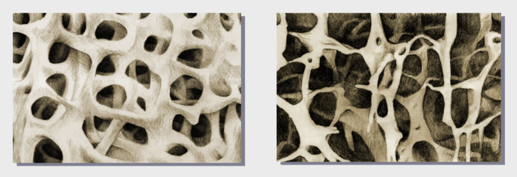 Bên trái: Xương bình thường. Bên phải: Loãng xương – rối loạn chuyển hóa bộ xương, tổn thương sức mạnh của xương, tăng nguy cơ gãy xương. Sức mạnh của xương gồm từ toàn vẹn về khối lượng và chất lượng của xương. (Trích báo cáo đề tài cấp nhà nước KC10.22/11-15)