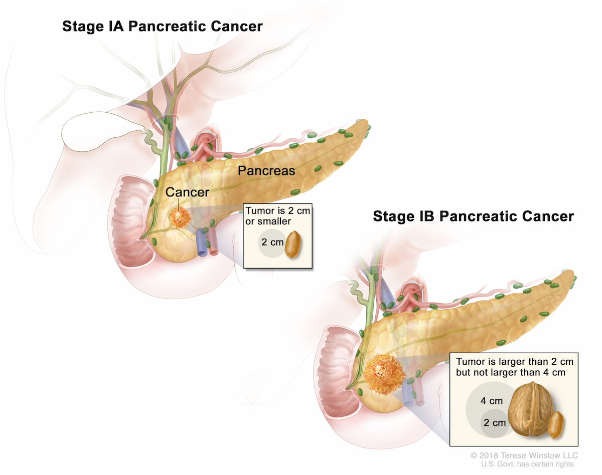 Tuyến tụy (pancreas) với kích thước khối u (cancer) theo từng giai đoạn.
